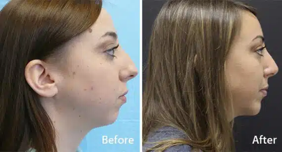 Chin Implants Before and After Photos in Princeton, NJ, Patient 6955