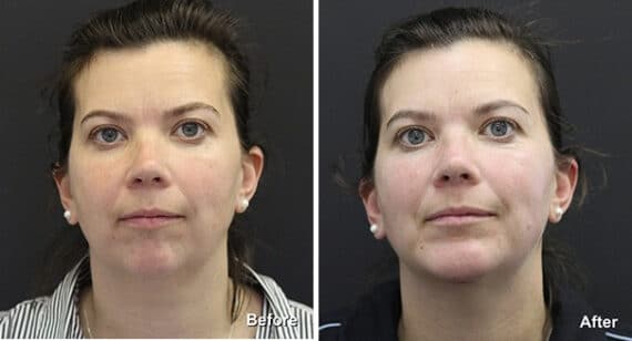 Chin Implants Before and After Photos in Princeton, NJ, Patient 6969