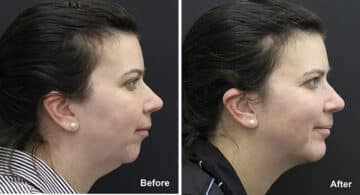 Chin Implants Before and After Photos in Princeton, NJ, Patient 6969