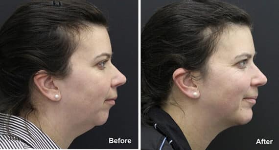 Chin Implants Before and After Photos in Princeton, NJ