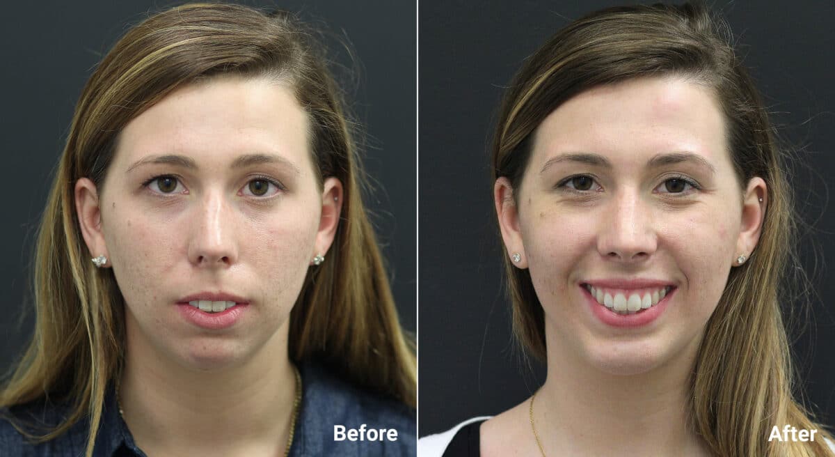 Chin Implants Before and After Photos in Princeton, NJ, Patient 6980