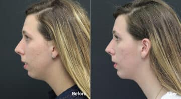 Chin Implants Before and After Photos in Princeton, NJ, Patient 6980