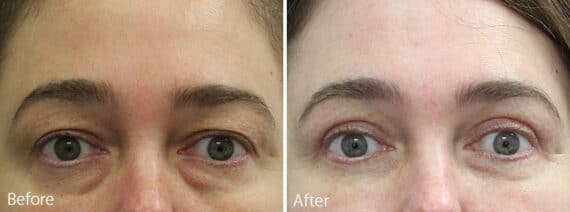 Upper and Lower Eyelid Surgery Before and After Photos in Princeton, NJ, Patient 6983