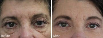 Upper and Lower Eyelid Surgery Before and After Photos in Princeton, NJ, Patient 6987