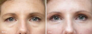 Upper and Lower Eyelid Surgery Before and After Photos in Princeton, NJ, Patient 6999