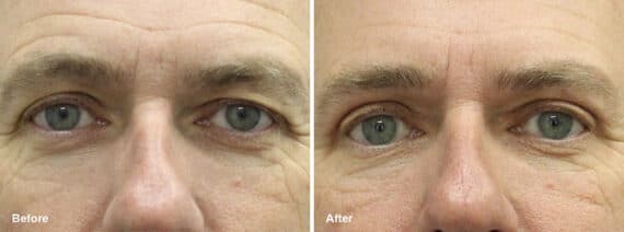 Upper Eyelid Surgery Before and After Photos in Princeton, NJ, Patient 7015