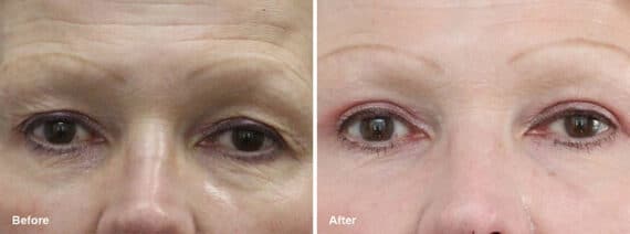 Upper and Lower Eyelid Surgery Before and After Photos in Princeton, NJ, Patient 7019