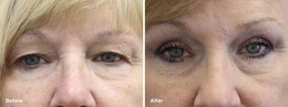 Upper Eyelid Surgery Before and After Photos in Princeton, NJ, Patient 7023