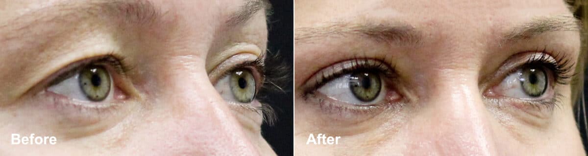 Upper Eyelid Surgery Before and After Photos in Princeton, NJ, Patient 7031