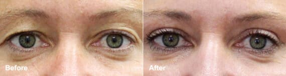 Upper Eyelid Surgery Before and After Photos in Princeton, NJ, Patient 7031