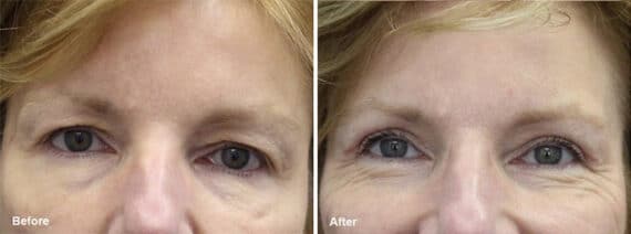 Upper Eyelid Surgery Before and After Photos in Princeton, NJ, Patient 7035