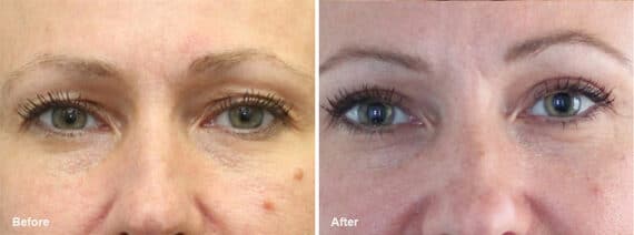 Upper Eyelid Surgery Before and After Photos in Princeton, NJ, Patient 7039