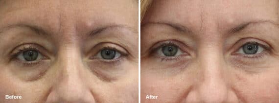 Lower Eyelid Surgery Before and After Photos in Princeton, NJ, Patient 7047