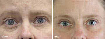 Upper and Lower Eyelid Surgery Before and After Photos in Princeton, NJ, Patient 7051