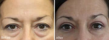 Upper and Lower Eyelid Surgery Before and After Photos in Princeton, NJ, Patient 7055