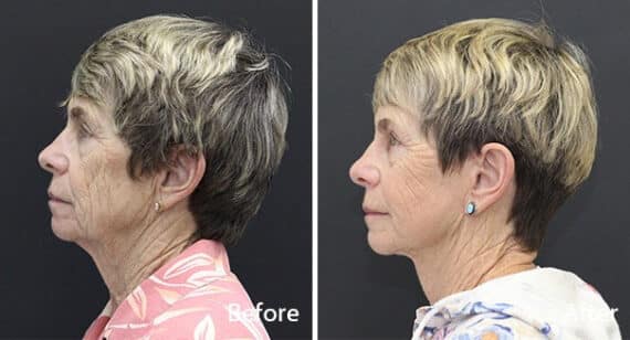 Facelift Before and After Photos in Princeton, NJ, Patient 7059