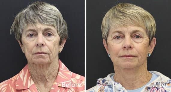 Facelift Before and After Photos in Princeton, NJ, Patient 7059