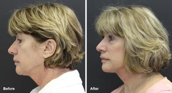 Facelift Before and After Photos in Princeton, NJ, Patient 7069