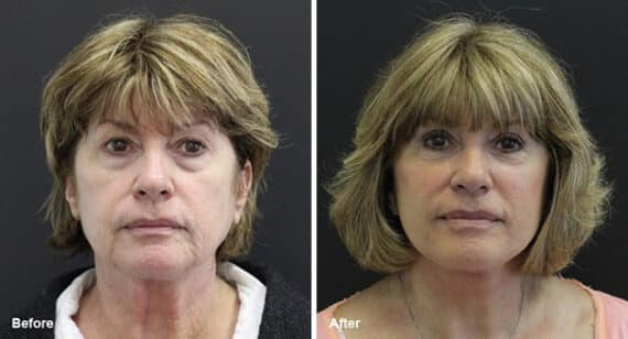 Facelift Before and After Photos in Princeton, NJ, Patient 7069