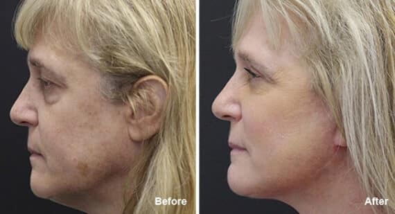 Facelift Before and After Photos in Princeton, NJ, Patient 7079