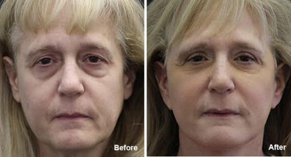 Facelift Before and After Photos in Princeton, NJ, Patient 7079