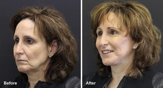 Facelift Before and After Photos in Princeton, NJ, Patient 7089