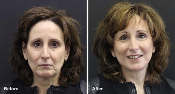 Facelift Before and After Photos in Princeton, NJ, Patient 7089