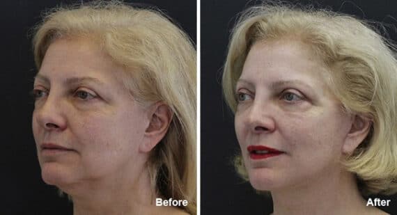 Facelift Before and After Photos in Princeton, NJ, Patient 7096