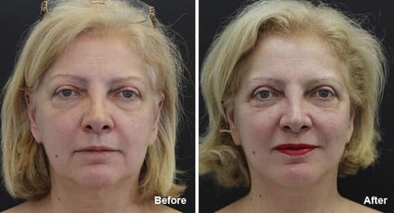 Facelift Before and After Photos in Princeton, NJ, Patient 7096