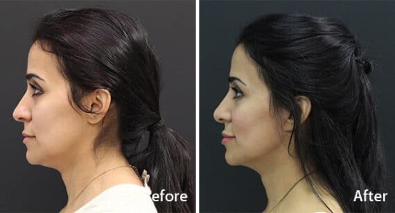 Facelift Before and After Photos in Princeton, NJ, Patient 7113