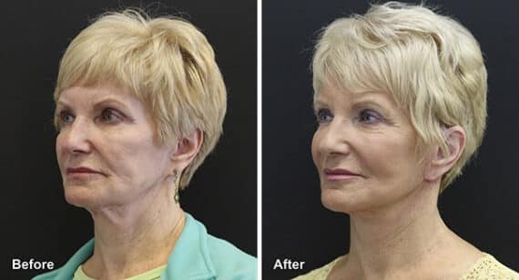 Facelift Before and After Photos in Princeton, NJ, Patient 7123