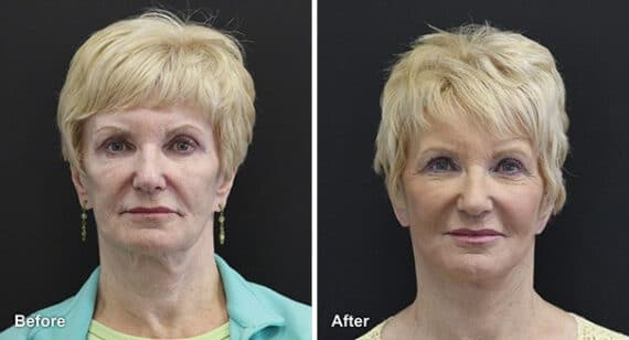 Facelift Before and After Photos in Princeton, NJ, Patient 7123
