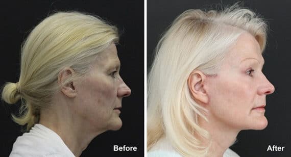 Facelift Before and After Photos in Princeton, NJ, Patient 7134