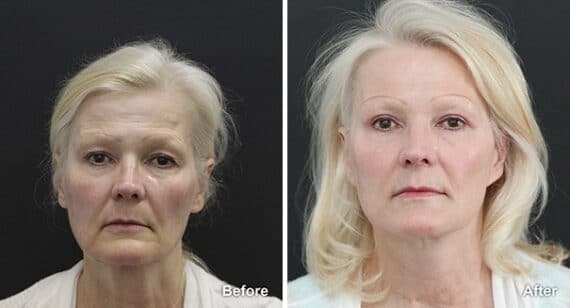 Facelift Before and After Photos in Princeton, NJ, Patient 7134