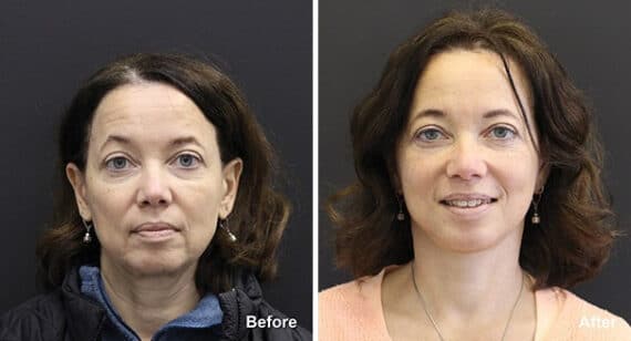 Facelift Before and After Photos in Princeton, NJ, Patient 7144