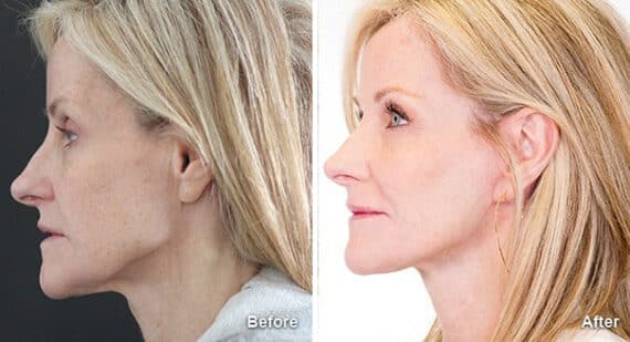 Facelift Before and After Photos in Princeton, NJ, Patient 7154