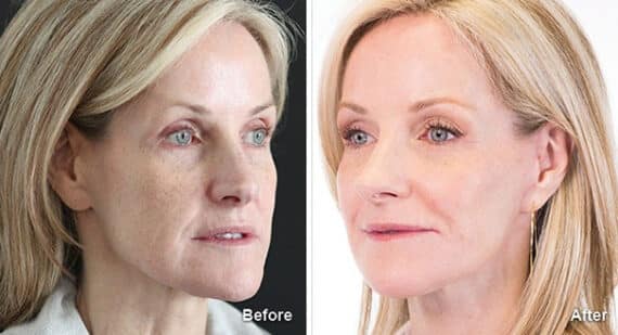 Facelift Before and After Photos in Princeton, NJ, Patient 7154