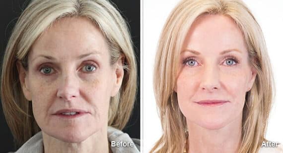 Facelift Before and After Photos in Princeton, NJ