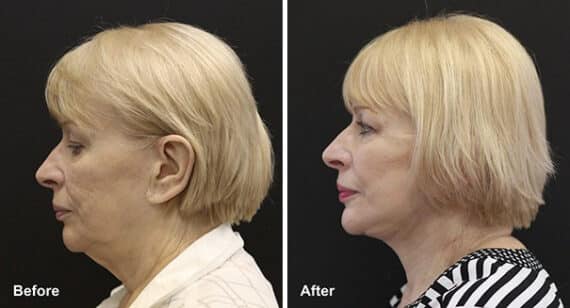Fat Transfer Before and After Photos in Princeton, NJ, Patient 7167