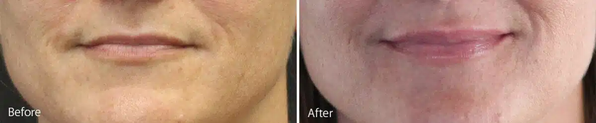 Lip Augmentation Before and After Photos in Princeton, NJ, Patient 7174