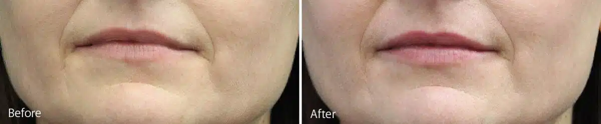 Lip Augmentation Before and After Photos in Princeton, NJ, Patient 7182