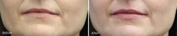 Lip Augmentation Before and After Photos in Princeton, NJ, Patient 7182