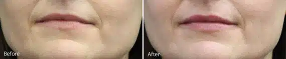 Lip Augmentation Before and After Photos in Princeton, NJ, Patient 7182