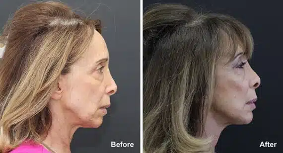 Neck Lift Before and After Photos in Princeton, NJ, Patient 7194