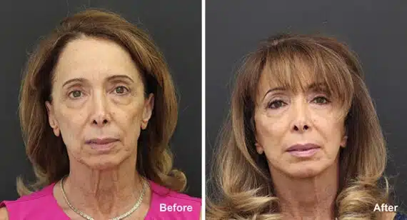 Neck Lift Before and After Photos in Princeton, NJ, Patient 7194