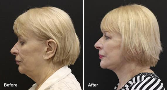 Neck Lift Before and After Photos in Princeton, NJ, Patient 7204