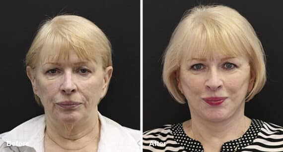 Neck Lift Before and After Photos in Princeton, NJ, Patient 7204