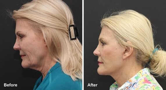 Neck Lift Before and After Photos in Princeton, NJ, Patient 7211