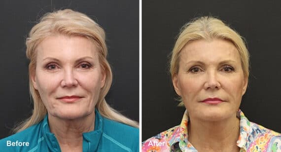 Neck Lift Before and After Photos in Princeton, NJ