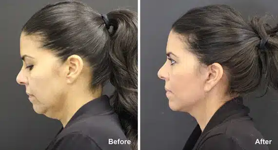 Neck Lift Before and After Photos in Princeton, NJ, Patient 7221